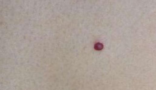 洪志|身体上莫名长出“小红痣”,是怎么回事?需要去做检查吗?