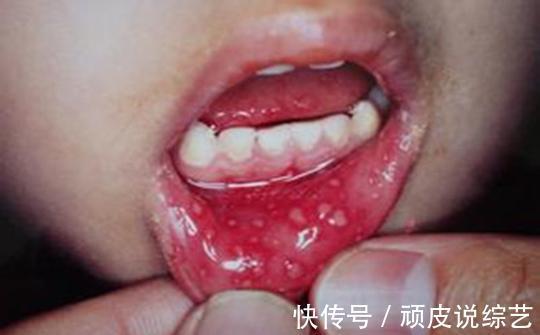 高发季|手足口病高发季已经来临,孩子身上出现这些症状,家长就要警惕