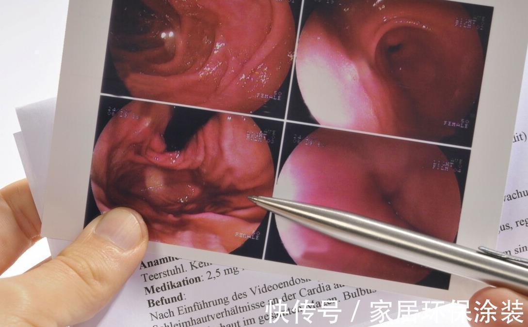 胃肠|胃肠检查做一大堆,都有什么用?胃肠检查的注意事项有哪些?