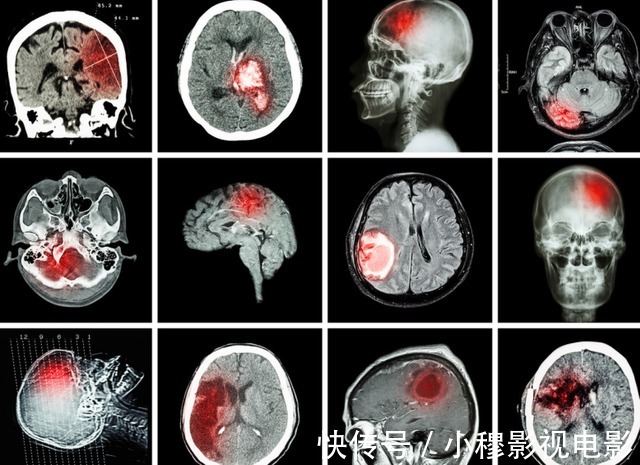 血栓|脑梗为何逐年增多？神经内科专家：或和3味调料有关，炒菜时少放