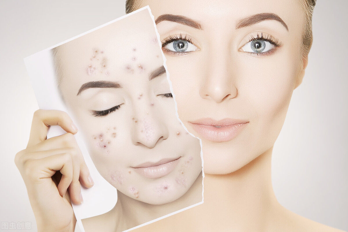 卵泡|长痘、喝水都胖,这个妇科病不仅影响颜值,还影响生娃