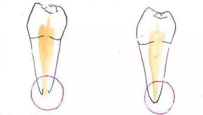 坏死|牙医姐姐讲故事︱断牙如何修补？别让意外“折”了童年的欢乐
