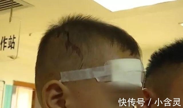 外伤|吓坏家长! 孩子早上起来满脸是血, 医生: 已收治十多名同情况小孩