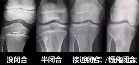 焦虑|牛奶当水喝?正骨长高?那些长个子的坑你信了几个