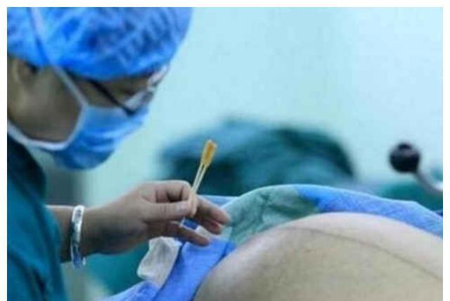 区别|第一次剖腹产和第二次剖腹产,到底有啥区别?疼痛度不同只是基础