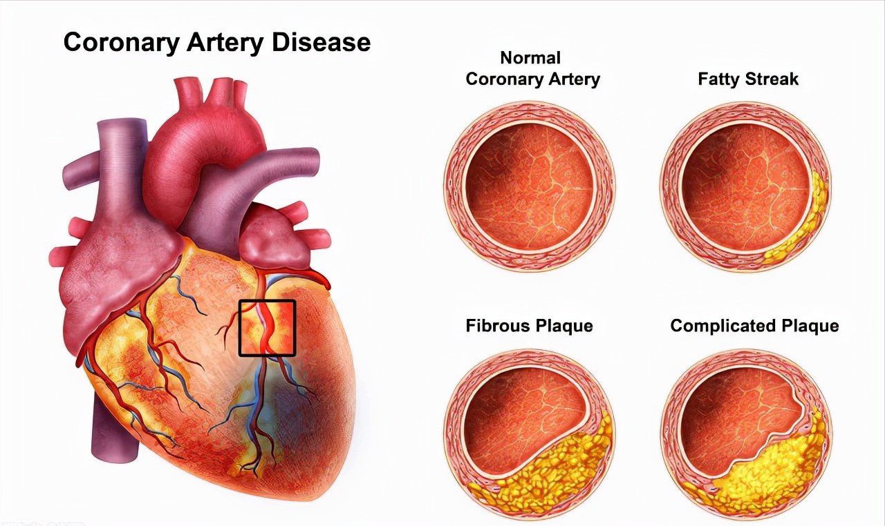冠心病|2个中成药，改善冠心病心绞痛，多靶点抗动脉粥样硬化，缩小斑块