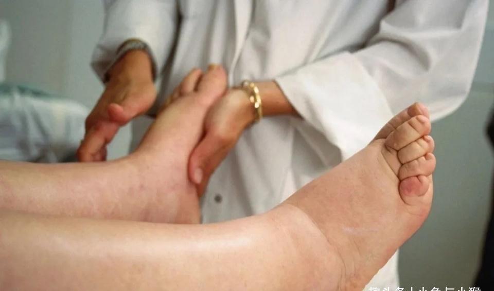 准妈妈|担心孕期水肿影响胎儿,23岁新手妈妈少喝水,医生说她自作聪明