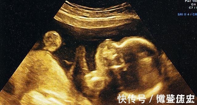 胎儿|孕期检查出胎儿“畸形”，是否应该生下来？专家：这些情况可以生