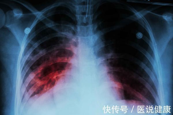 油烟|气多伤肺?提醒:这5种伤肺的“气”,劝你可别不当回事