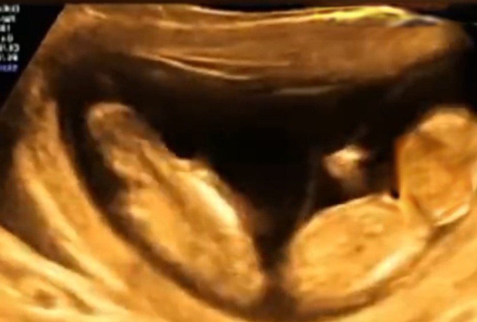 忍俊不禁|孕妈做四维彩超时突然腹痛,B超显示让人忍俊不禁,网友:挺无辜