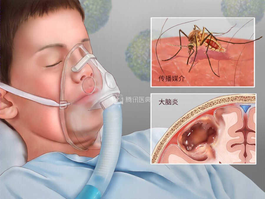 发病|最毒不过秋蚊子，小心被叮患乙脑