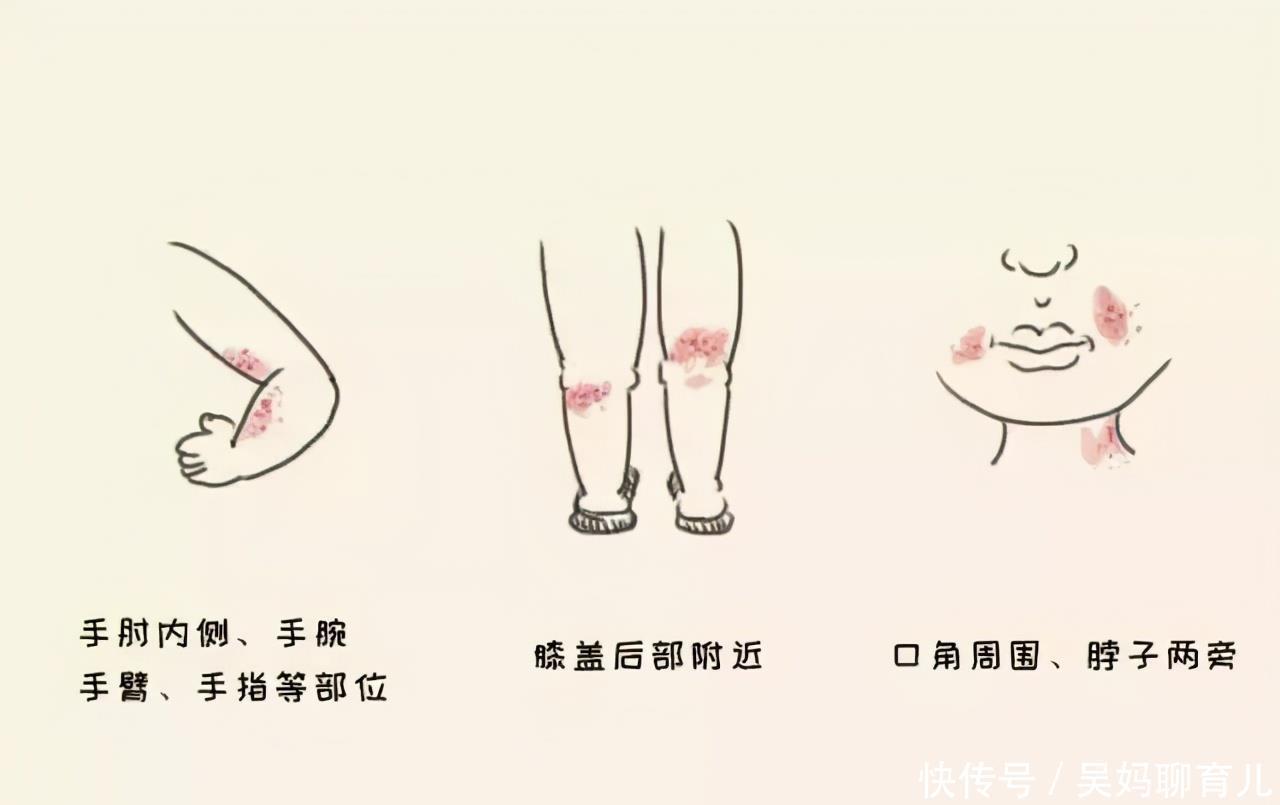 皮肤病|痒痒痒!湿疹这“妖孽”很磨人,反反复复怎么破?五招轻松护理