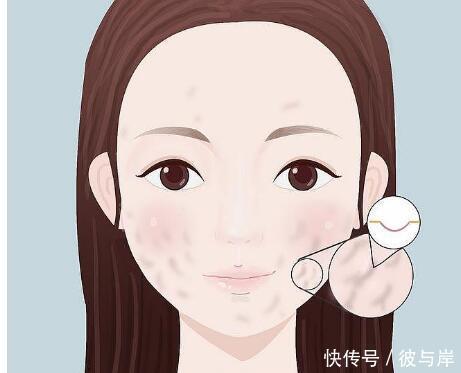 祛痘印方法用不对可能伤害皮肤!做到4点,更科学的祛痘印