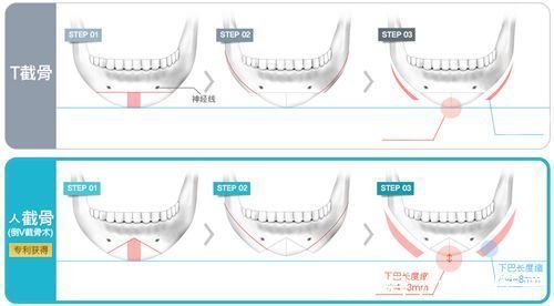 操作方法 下巴截骨术危险吗？手术注意事项须知及术后怎么护理？看完全明白了！