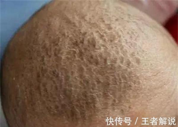 植物油|新生儿头上脏脏，忍不住用手去抠？当心把宝宝抠进医院