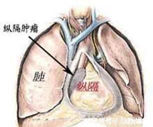 胸片|55岁男子,体检正常5个月后查出晚期肺癌去世体检到底有何用