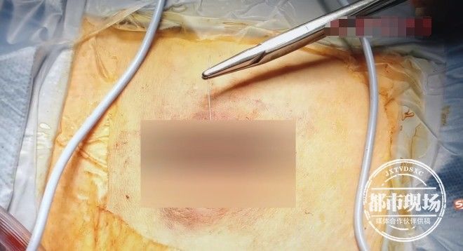 梁婆婆|67岁老人自行针灸,针断腹中!她又想自己开口子取出