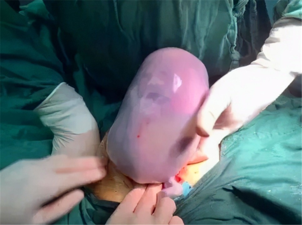 小宝宝|90后宝妈生出“果冻宝宝”,陪产宝爸吓得脸发白,医生却说恭喜