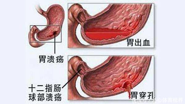 心梗怎么能是吃阿司匹林引起的?服用阿司匹林8大注意事项要清楚