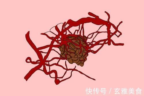 院士|查出癌症，就一定要手术切除？院士的肺腑之言，也许得听一听