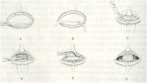 上睑下垂眼无神,做个双眼皮手术就能搞定吗?