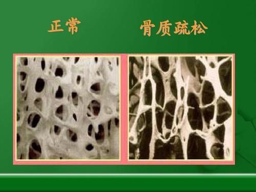出现这四种症状，小心骨质疏松症
