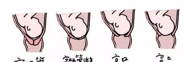 劳动力|分娩时,这4种孕妇“开十指”速度快,少遭罪,看看有没有你!