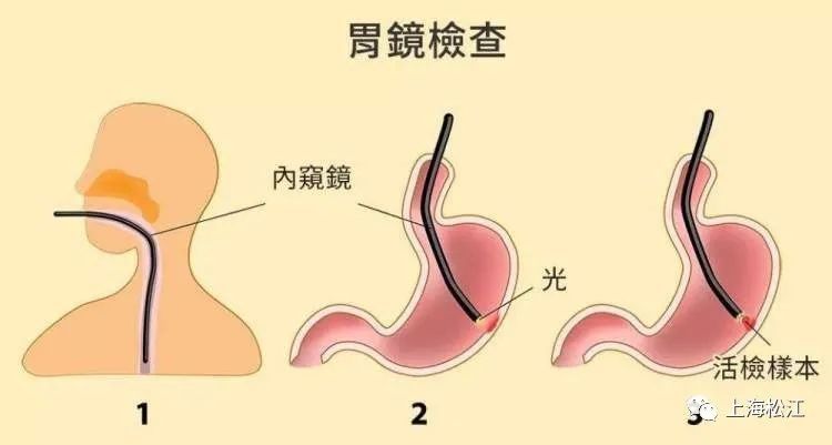  发现|胃癌如何早发现、早诊断、早治疗？松江医生提醒注意这些