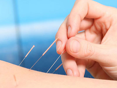 放血疗法|刺血不传之秘!20个最有用的针刺处方和25个放血疗法!赶紧收藏