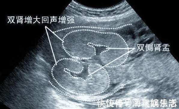 尿液|胎儿双肾盂分离，孕妇很高兴，“这下儿女双全了”，医生苦笑摇头