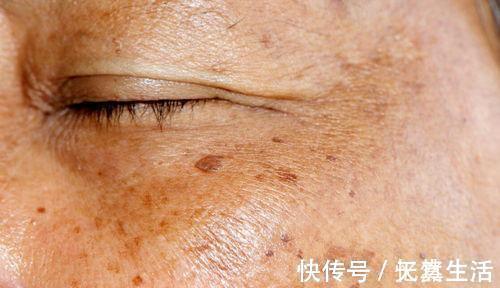 肥肉|血脂高都是肥肉造成的？醫生：不是！這3物才是血脂的“加速器”