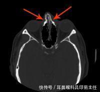 打架鼻骨骨折赔多少钱