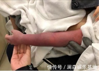 截肢|宝爸宝妈们,这些东西你家都有,它可能会导致宝宝面临截肢!