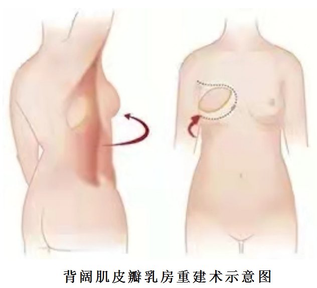 腔镜|潍坊市中医院成功完成腔镜下全背阔肌乳房重建手术