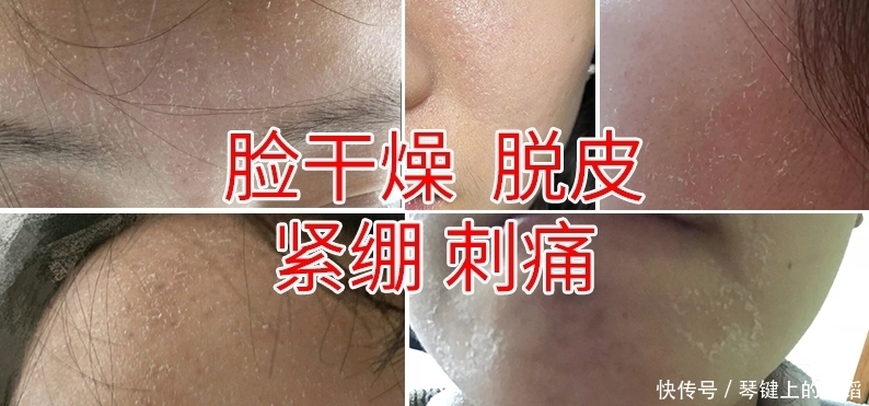 脸干燥脱皮紧绷刺痛怎么快速恢复?脸干怎么办才能补水快?