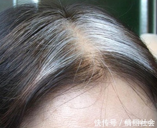 白发|一把花椒就能改善白头发中医告诉你真相,预防白发让头发变健康