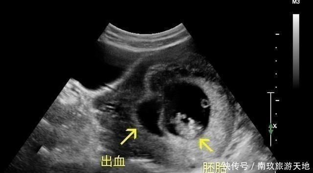 怀孕|胎停并非“毫无征兆”,孕妇出现这5个表现,可能是胎儿不发育了