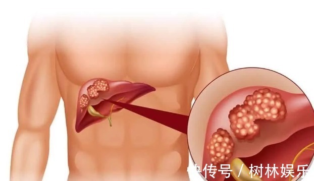 科室|结节、息肉、囊肿、增生哪个最可能癌变这么多年疑惑终于解开了