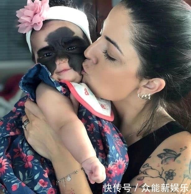 外科医生|真人版“蝙蝠侠”,美国一婴儿患罕见黑色素痣,形状酷似蝴蝶翅膀