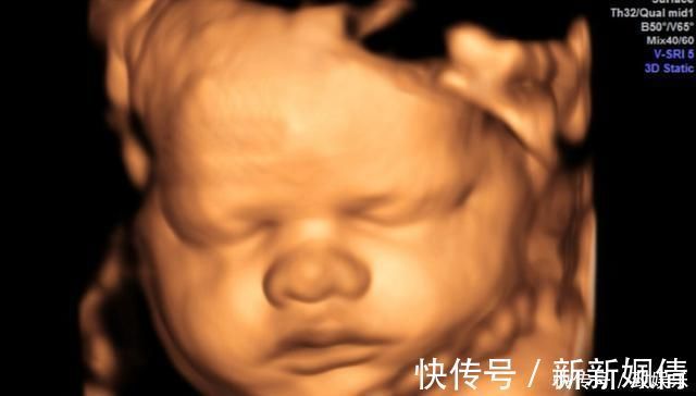 排畸|孕妈做排畸检查,医生说太胖看不到孩子的脸,孕妈该咋做呢