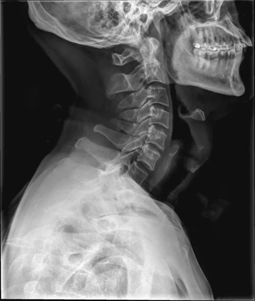 椎体|脊柱常见肿瘤及肿瘤样病变的几种影像学表现，你都见过吗？