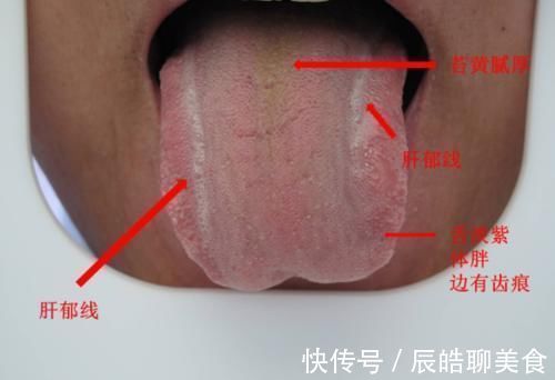 糖尿病|80后精神小伙患2型糖尿病,医生感叹太年轻,5种舌象很常见要当心