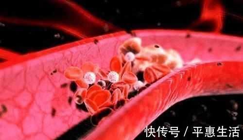 血管|50岁后,有四个习惯的人最易发生脑梗,三个信号能抓住一个就很好