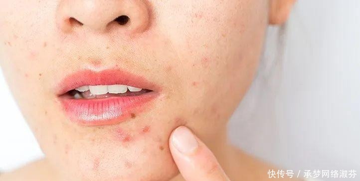 激素脸|为什么很多女生不护肤反而皮肤更好？坚持做这3件事，皮肤都不差