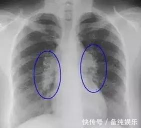 腎囊腫|體檢查出結節、息肉、增生、囊腫，哪個是癌癥的先兆
