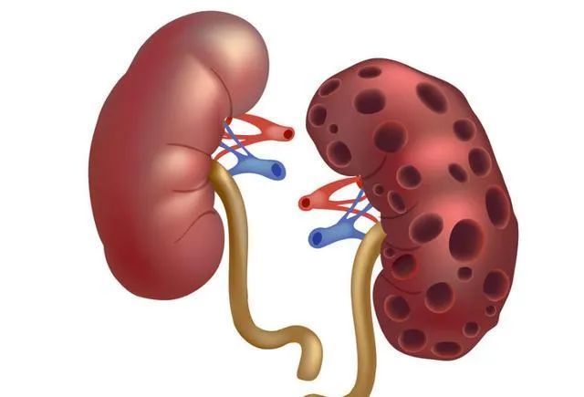 26岁男子,痛风入院,并发肾衰竭,一个行为害得,再难也要改