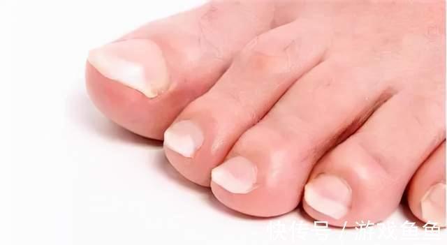 肝腹水|身体三个地方发生变色，糟糕，肝硬化已经悄悄找上你，别大意