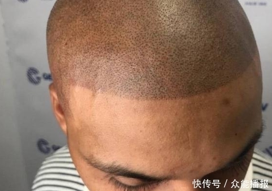 纹身|秃顶男子想要头发,无奈请纹身师纹头发,这效果让人哭笑不得