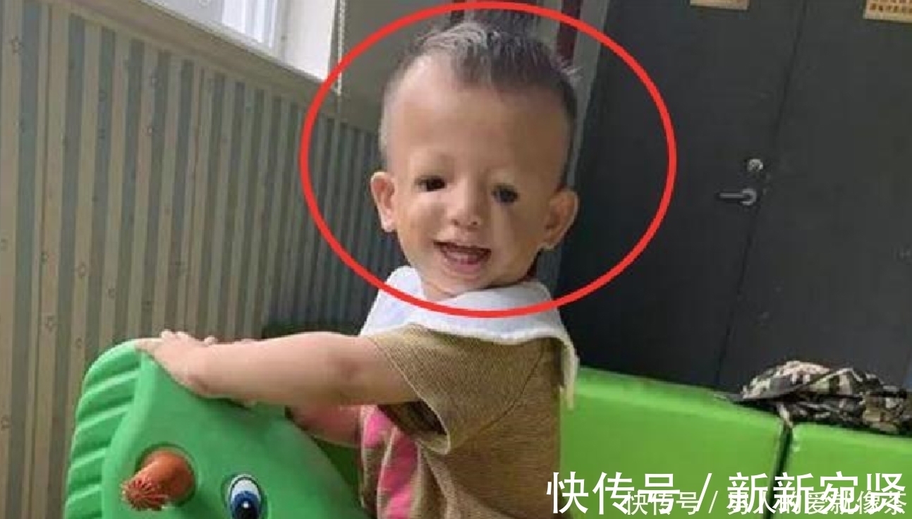 遗传性|“鸟脸”妈妈执意生“二胎”,产下孩子容貌引争议,如今后悔了!