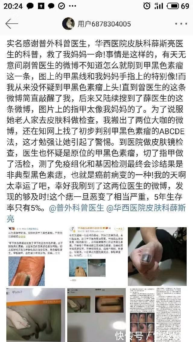 癌症|指甲上有黑线，可能是最恶的癌症，医生教你怎么办